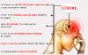 Orthèse de soutien et de positionnement Epaule-bras-main après Accident Vasculaire Cérébral AVC